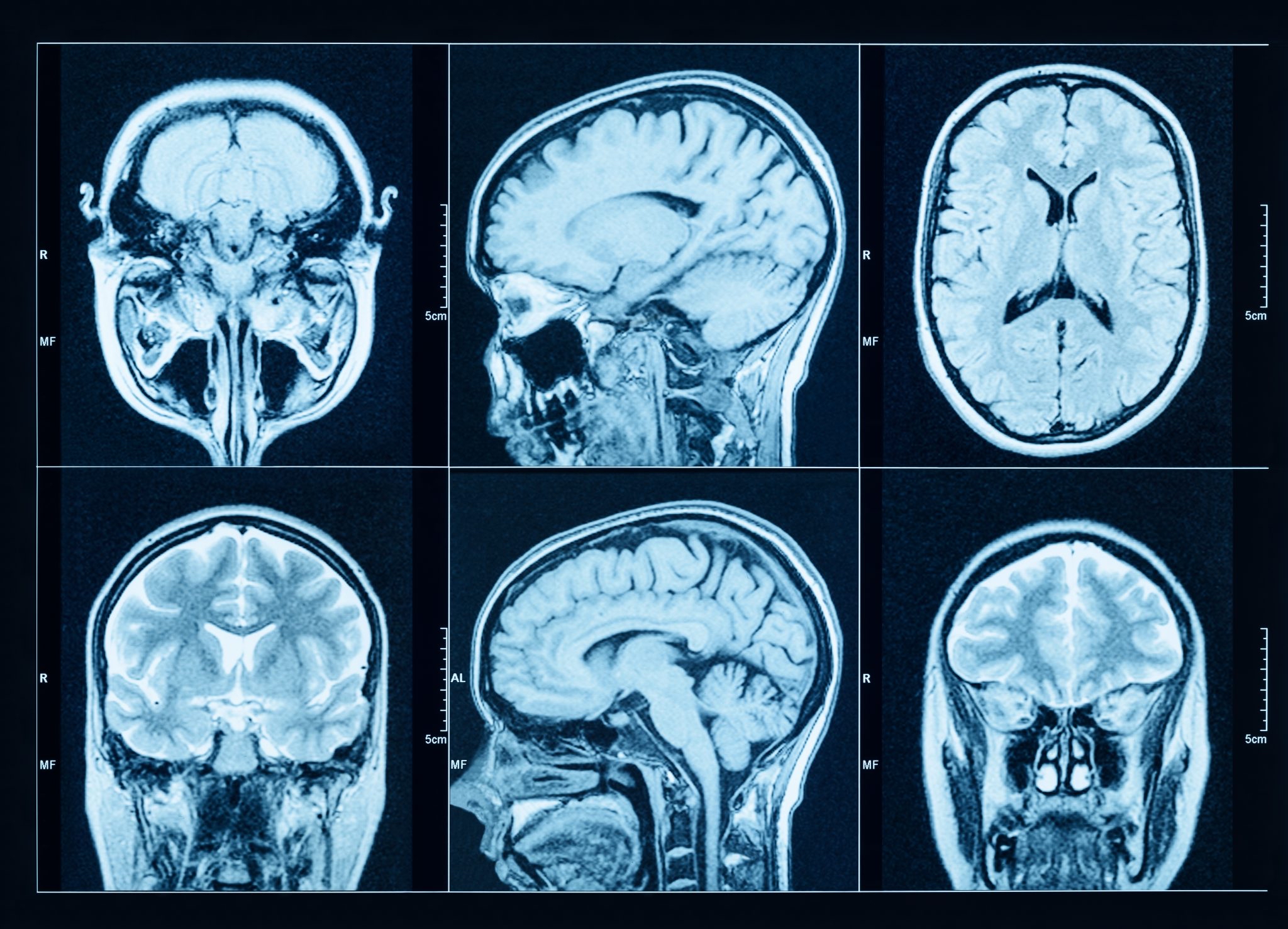 Parkinson’s disease is on the rise — and experts say there are things you can do now to reduce your risk